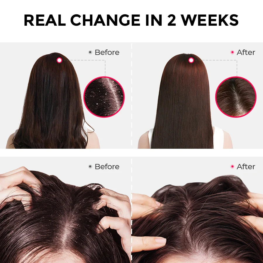 TYMO Anti-Dandruff Shampoo Powder