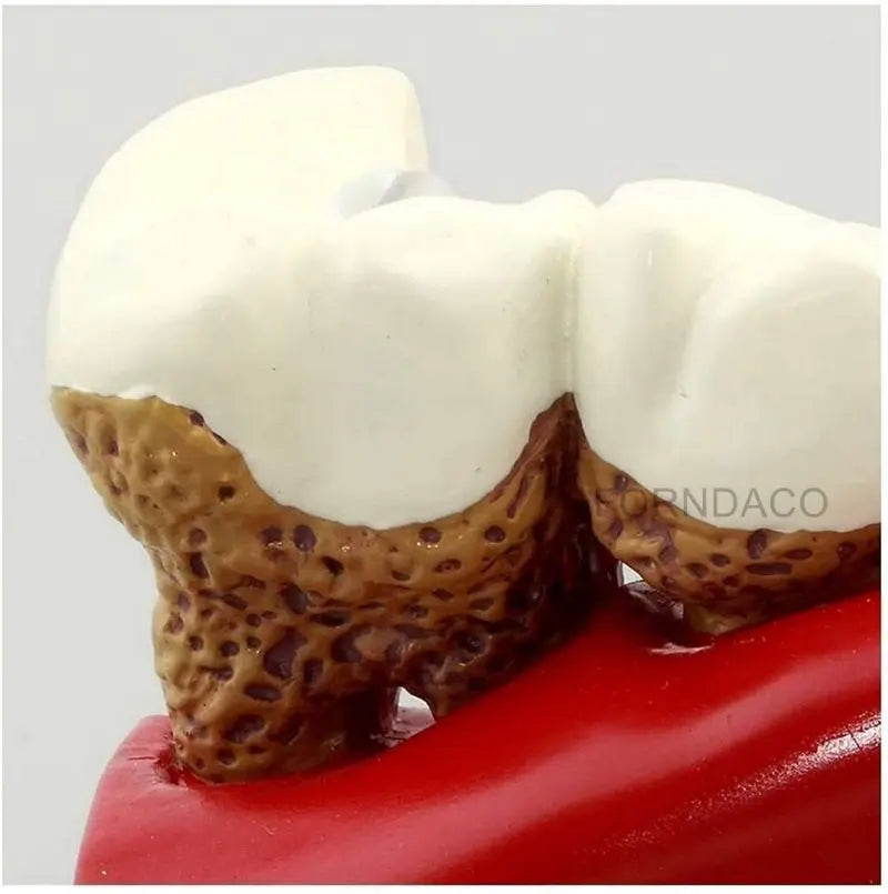 Demonstration Dental Anatomy Caries Oral Model Medical Teaching Study Communication