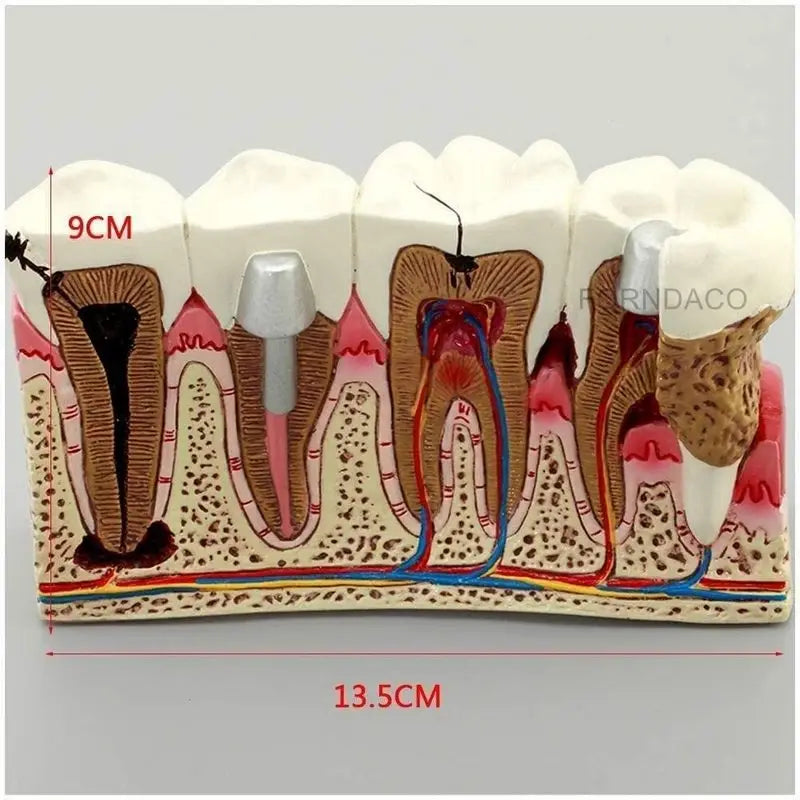 Demonstration Dental Anatomy Caries Oral Model Medical Teaching Study Communication