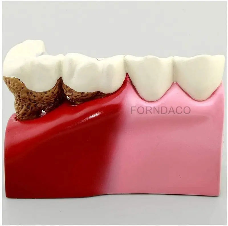Demonstration Dental Anatomy Caries Oral Model Medical Teaching Study Communication