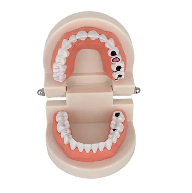 Dental Model Brushing Teeth Education Model Caries Tooth Care Oral Hygiene Studying Teaching Demonstration Dentistry Products